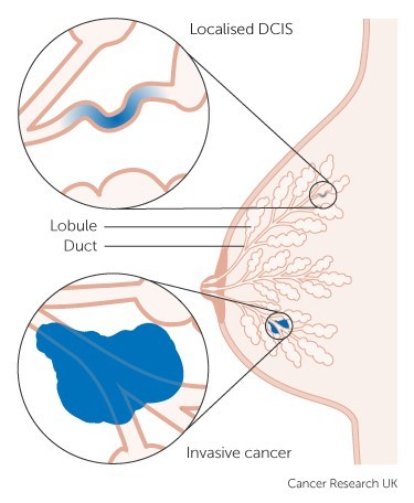 typesofbreastcancer_preinvasive.jpg