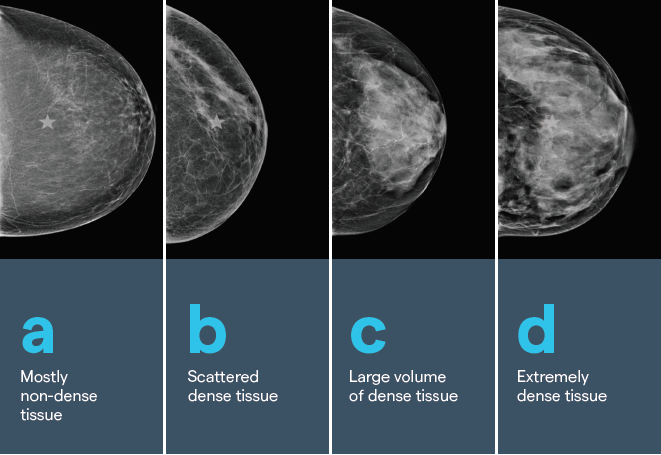 Breast density